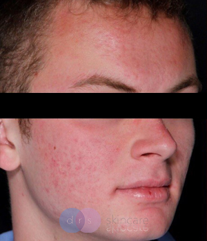 Before - Acne Scarring, Morpheus & CO2