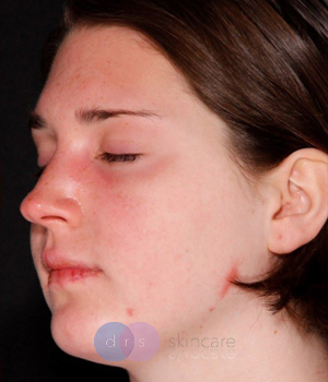 After - Acne Treatment