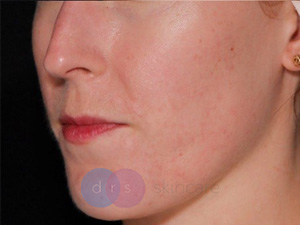 After - Acne Scarring, Morpheus & CO2