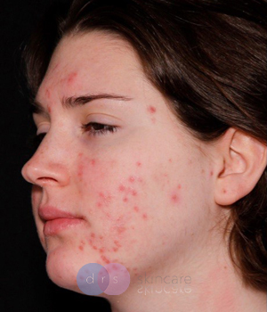 Before - Acne Treatment