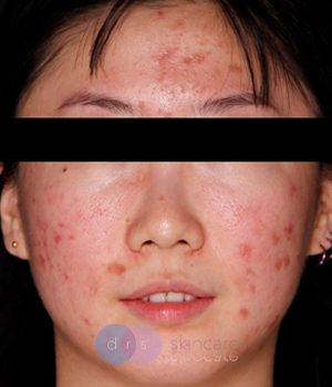 Before - Acne Treatment