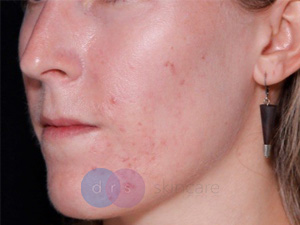Before - Acne Scarring, Morpheus & CO2