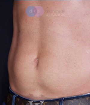 After - Body Contouring