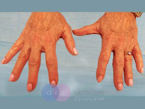 Hyaluronic Acid Filler on the hands - 1 treatments before