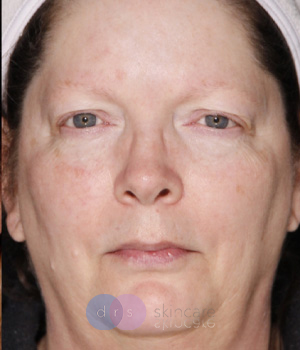 After IPL and Excel V full face treatment Hamilton, ON