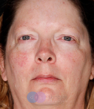 Before IPL and Excel V full face treatment Hamilton, ON