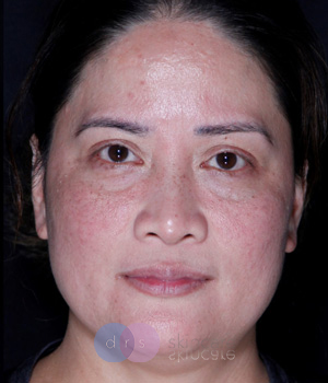 After Laser Genesis (6 Sessions) treatment Hamilton, ON