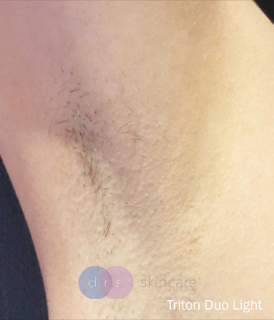 After - Laser Hair Removal