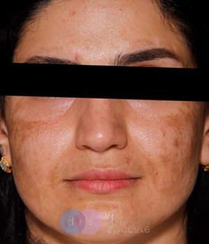 Before - Melasma, Brown spots & Skincare