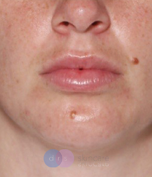 After - Microneedling