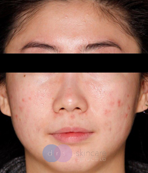 After - Microneedling