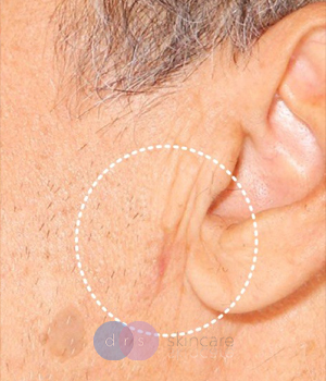 After - Moles and Skin Tags