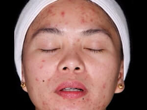 Before Acne therapy, Skin care, and Chemical peels
