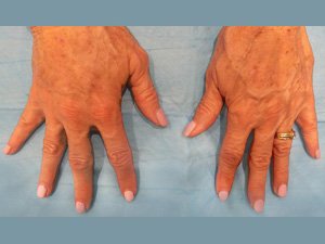 Hyaluronic Acid Filler on the hands - 1 treatments after