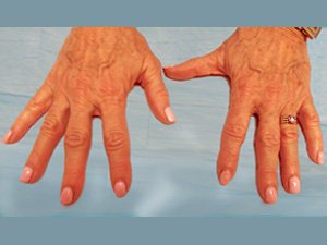 Hyaluronic Acid Filler on the hands - 1 treatments before