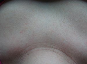 Treated telangiectasia After 02