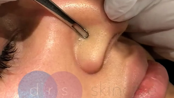 Silk Peel Microdermabrasion – EXTRACTION ON THE NOSE