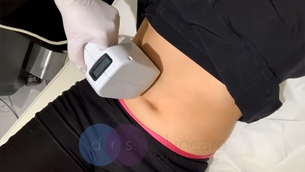 Body FX, the ideal treatment to melt fat and tighten skin