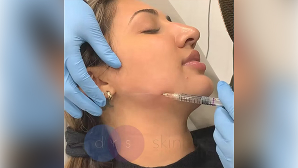 Restore lost facial volume and youthful looks with soft-tissue fillers