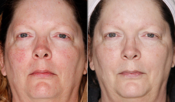 Before After Lumecca_Excel V treatment Hamilton, ON