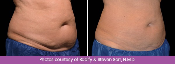 Before and After CoolSculpting Treatment Images