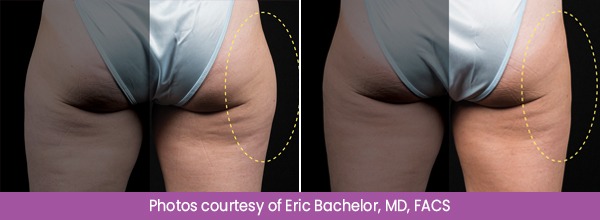 Before and After CoolSculpting Treatment Images
